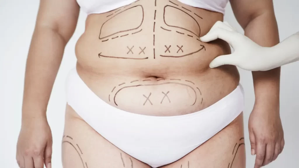 Fibrose pós-lipo é uma das principais preocupações de quem passou por lipoaspiração e começa a notar caroços, ondulações ou áreas endurecidas na pele.